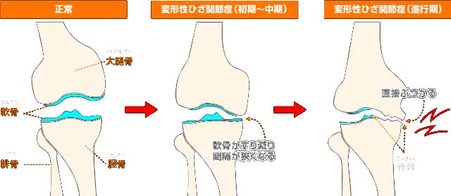膝の痛み・膝関節痛